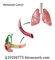 סרטן, התפשט, דרך, דם