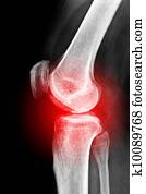 רנטגן, של, a, ברך כואב