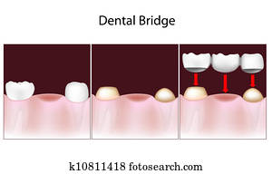 של השיניים, גשור, פרוצדורה