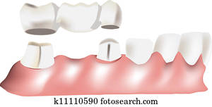 של השיניים, גשור