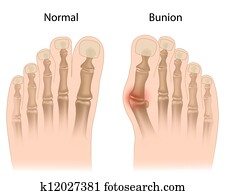 Bunion in foot, eps10 Bunion in foot, eps10
