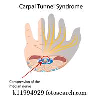 Carpal tunnel syndrome, eps10 Carpal tunnel syndrome, eps10