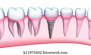 dental, implante, detalhado, vista