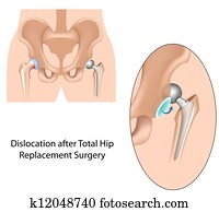Dislocation after hip replacement Dislocation after hip replacement