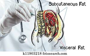 doctor draws abdominal fat doctor draws abdominal fat