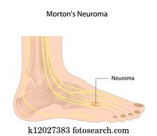 morton%u2019s, neuroma,, eps10 morton%u2019s, neuroma,, eps10