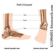 pott's, fracture,, eps8