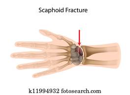 Scaphoid wrist fracture, eps10 Scaphoid wrist fracture, eps10