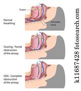 Snoring and sleep apnea, eps10 Snoring and sleep apnea, eps10
