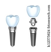 Tooth implant. Tooth implant.