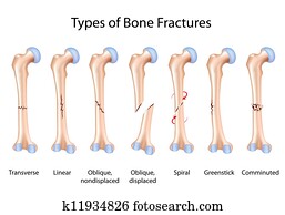 סוגים, של, עצם, fractures,, eps8