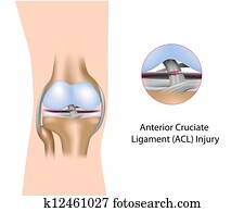 קדמי מיתר של כראכיאט, פגיעה