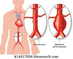Abdominal aortic aneurysm Abdominal aortic aneurysm