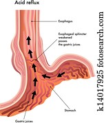 Acid reflux Acid reflux
