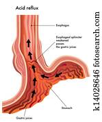 Acid reflux Acid reflux