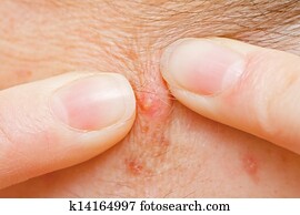 Acne squeezing Acne squeezing