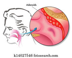 adenoids adenoids