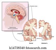 Brain damage in Alzheimer's Brain damage in Alzheimer's