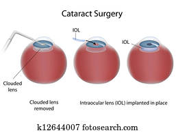 Cataract surgery, eps10 Cataract surgery, eps10