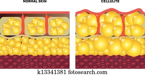 Cellulite and normal skin