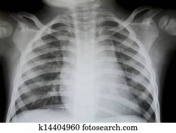 Chest x-ray. Chest x-ray.