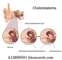 cholesteatoma,, eps10 cholesteatoma,, eps10