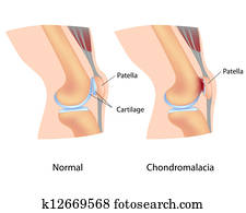 chondromalacia,, eps8