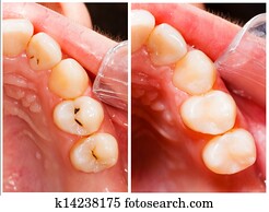 Composite Filling Material Composite Filling Material