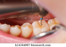 Dental drilling Dental drilling