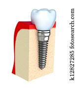 Dental implant in jaw bone Dental implant in jaw bone