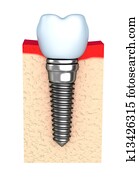 Dental implant in jaw bone Dental implant in jaw bone