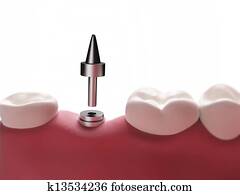 Dental implant Dental implant