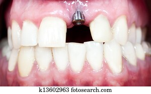 dental implant