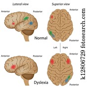 Dyslexia, eps10