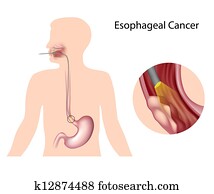 Esophageal cancer , eps10 Esophageal cancer , eps10
