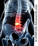 Highlighted - herniated disk Highlighted - herniated disk