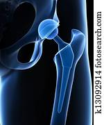 Hip replacement Hip replacement