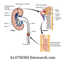 Kidney stone formation Kidney stone formation