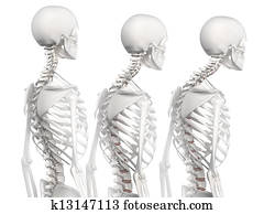 Kyphotic spine in 3 phases Kyphotic spine in 3 phases