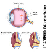 Macular hole, eps8 Macular hole, eps8
