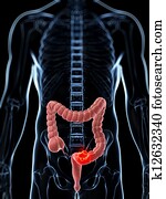 Male colon - cancer Male colon - cancer