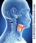 Male larynx - cancer Male larynx - cancer