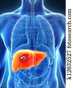Male liver - cancer Male liver - cancer