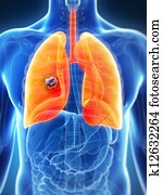 Male lung - cancer Male lung - cancer