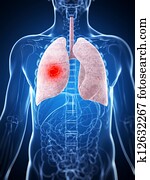 Male lung - cancer Male lung - cancer
