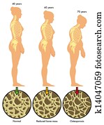 osteoporose, 3