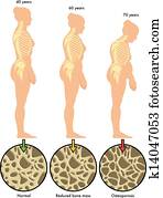 osteoporosis 3 osteoporosis 3