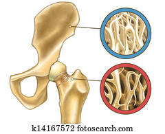 Osteoporosis Osteoporosis