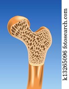 osteoporosis osteoporosis