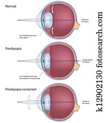 Presbyopia, eps8 Presbyopia, eps8